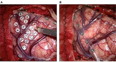 Intraoperative Neuromonitoring During Resection of Gliomas Involving Eloquent Areas